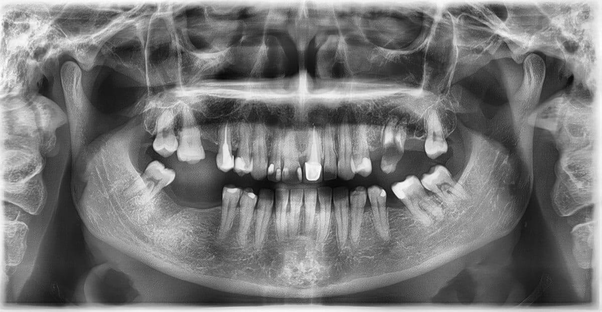 pantomogram